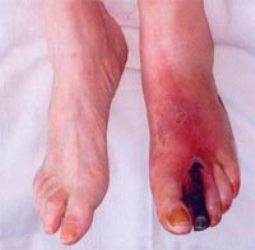 gangrena2 гангрена