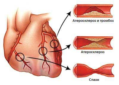 angiopl6 1