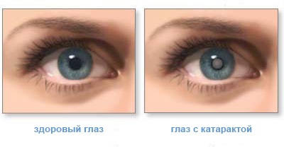 Катаракта