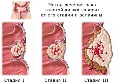 Рак прямой кишки