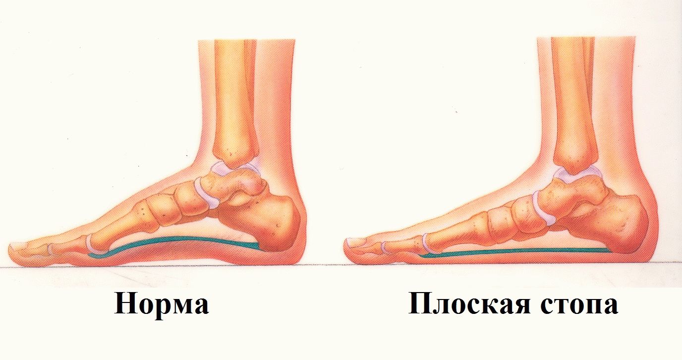 Плоскостопие, нога, ноги, стопа, обувь при плоскостопии