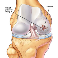 Лечение коленного сустава в бишкеке thumbnail