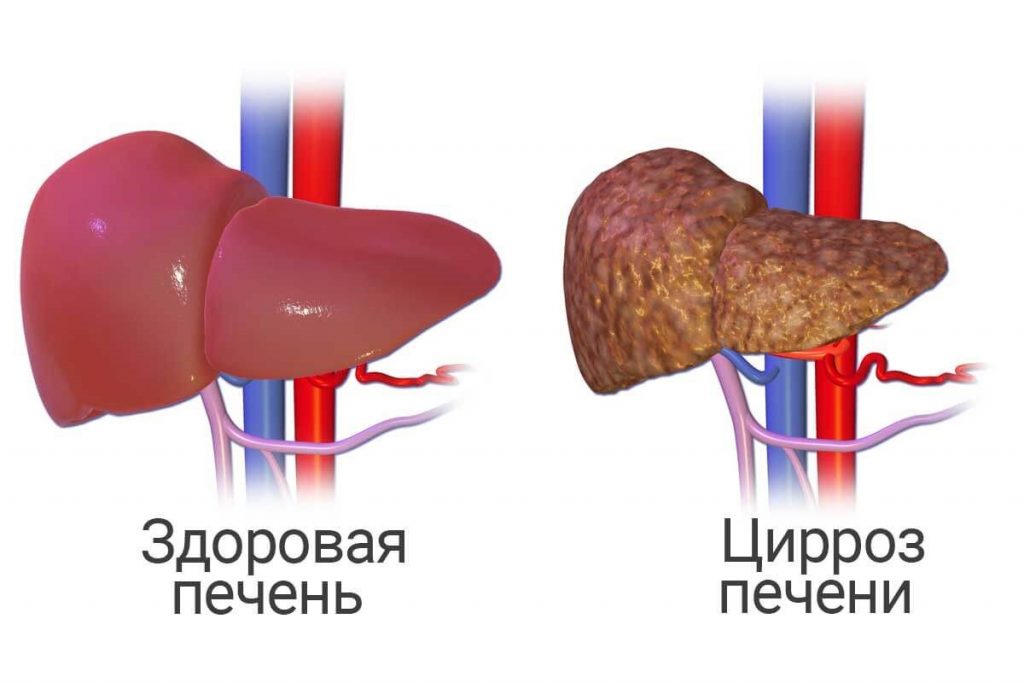 Гепатит алкогольный острый
